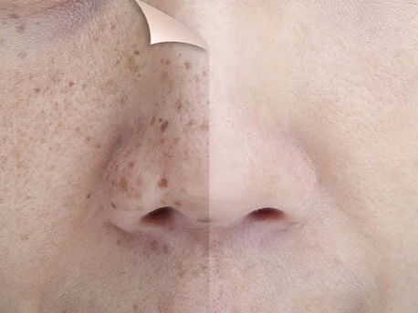 hyperpigmentation facial near me