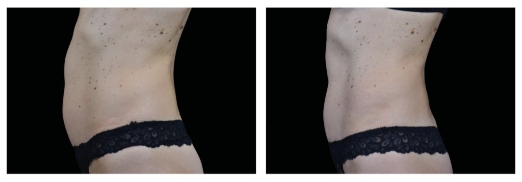 Emsculpt_neo_PIC_Ba-card-female-abdomen.jpg