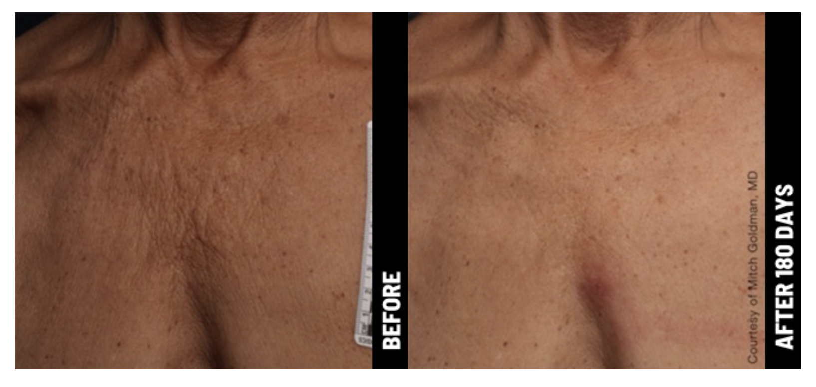 before-and-after-ultrasound-treatment-neck.png