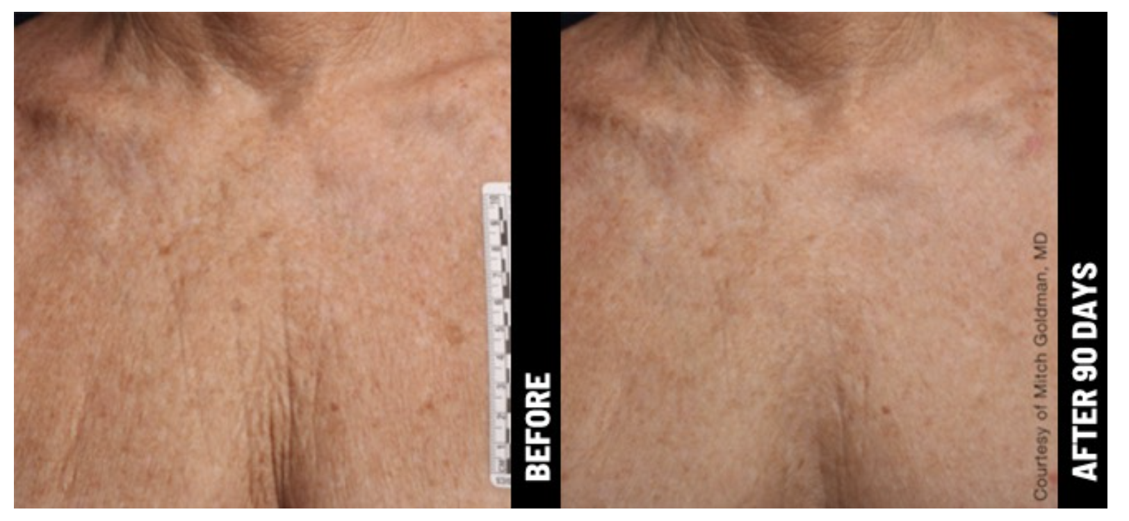 before-and-after-ultrasound-treatment-deck.png