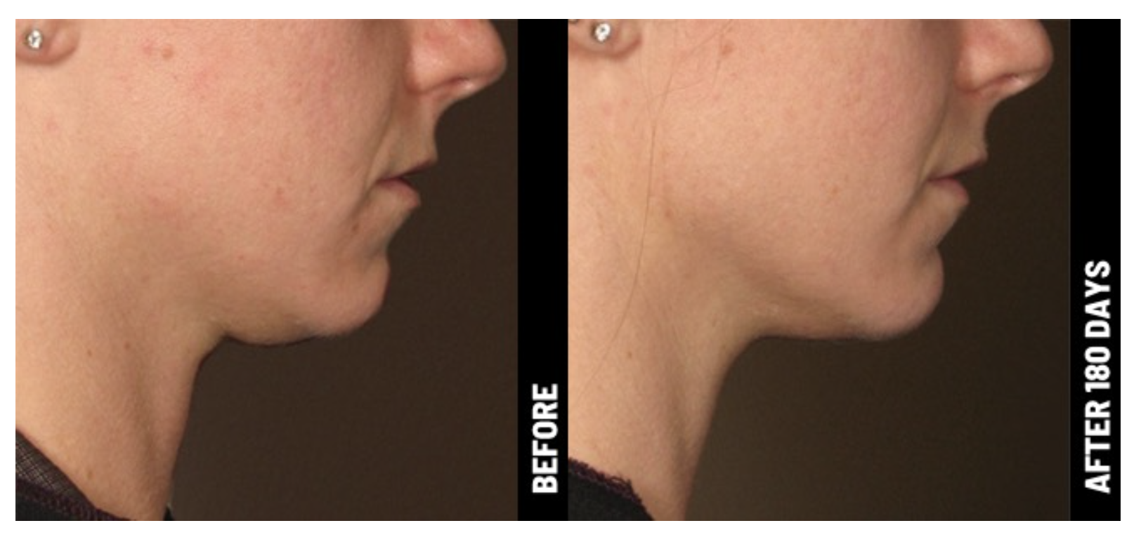 before-and-after-image-ultherapy-chest.png