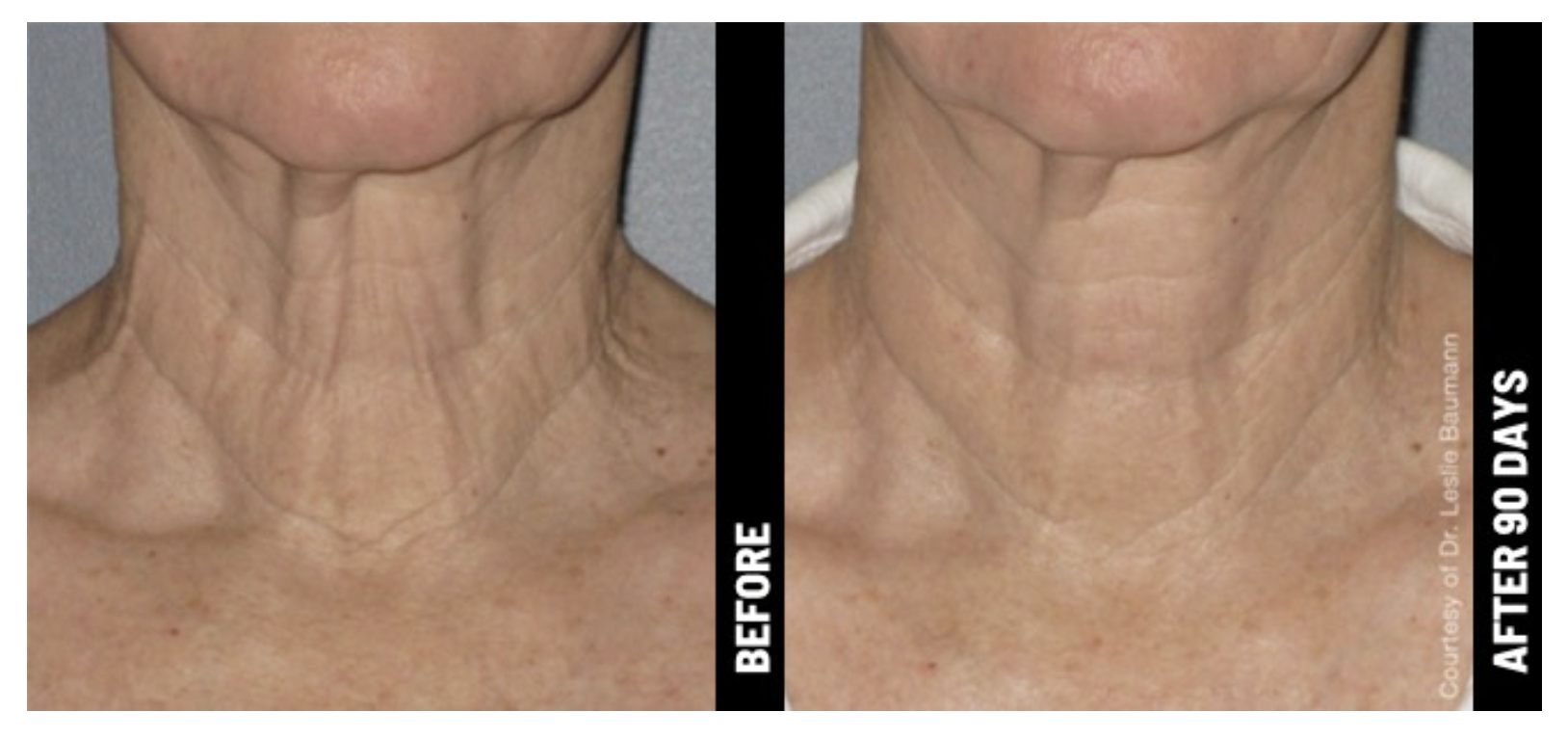 before-and-after-image-ultherapy-neck.png