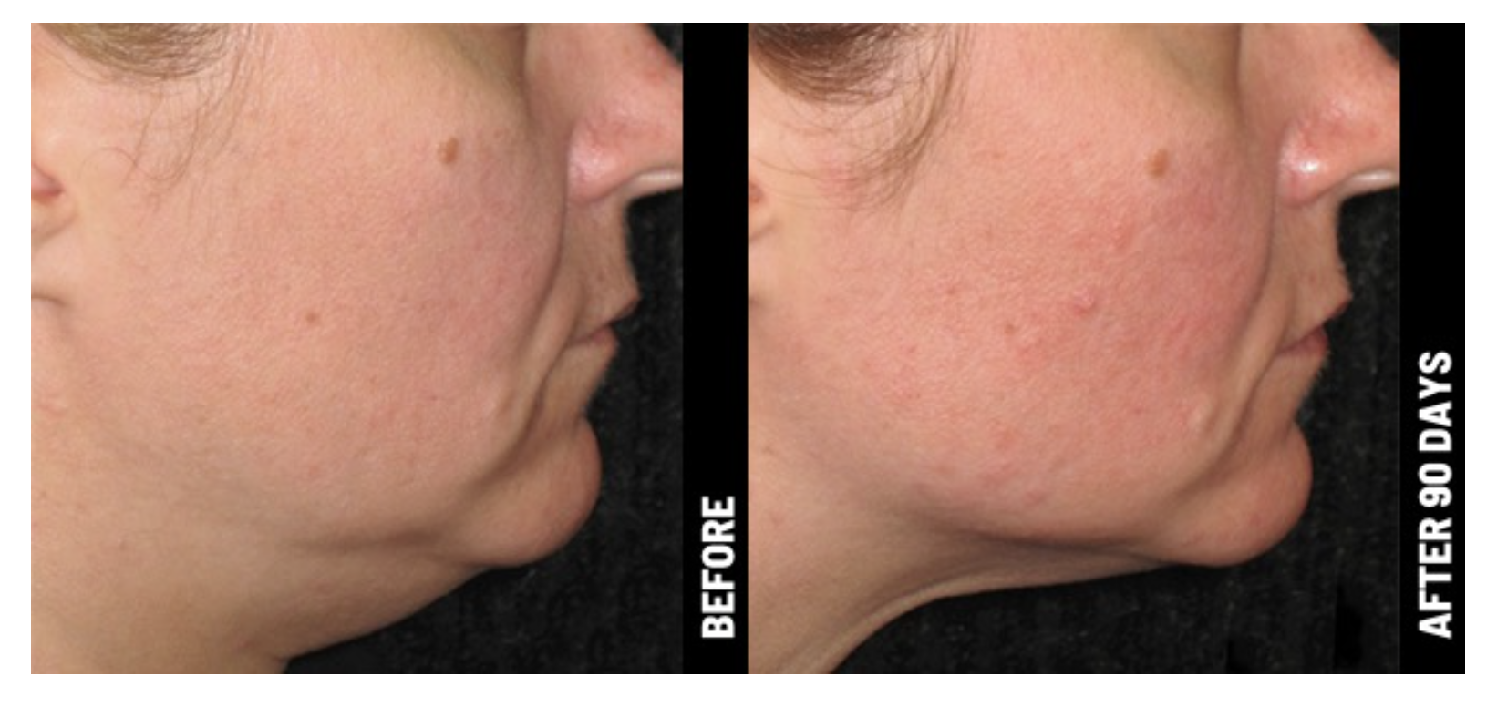 women-before-and-after-image-ultherapy-chin.png