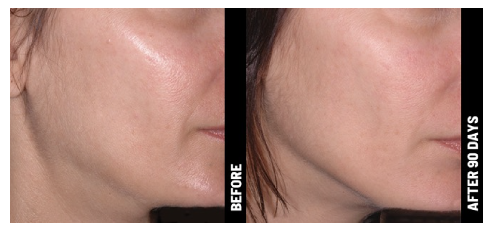women-before-and-after-image-ultherapy-chest.png