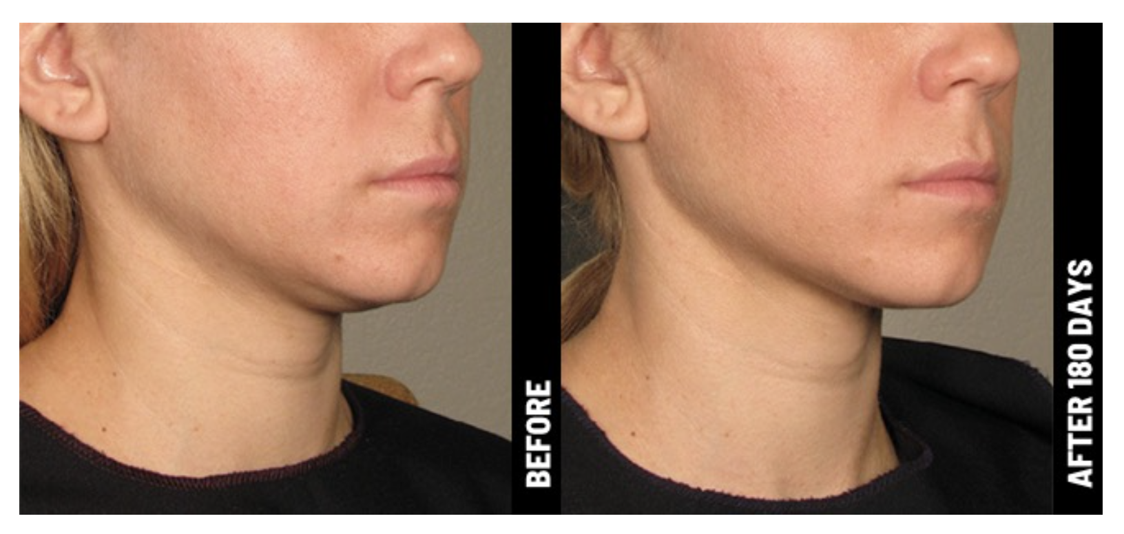 women-before-and-after-image-ultherapy-cheek.png