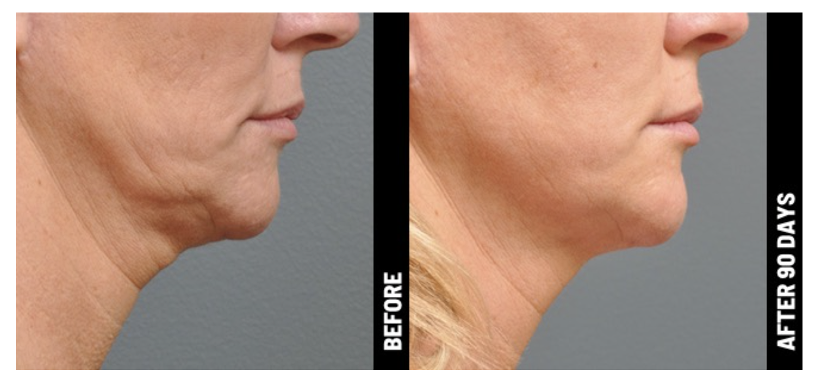 women-before-and-after-image-ultherapy-face-and-neck.png