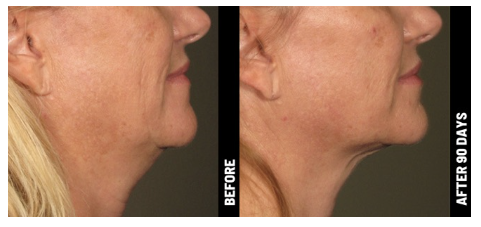 women-before-and-after-image-ultherapy-neck.png