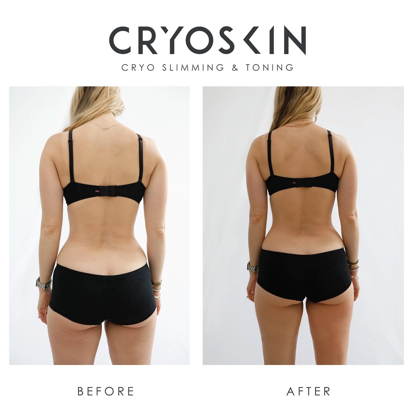 ✨ Before &amp; After: Cryo-Slimming Transformation! ❄️

In just 6 to 8 sessions, our clients are achieving incredible results with Cryo-Slimming! This non-invasive treatment uses advanced cooling technology to target and freeze stubborn fat cells, al