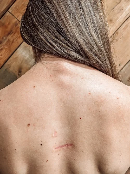 Acupuncture for Scars