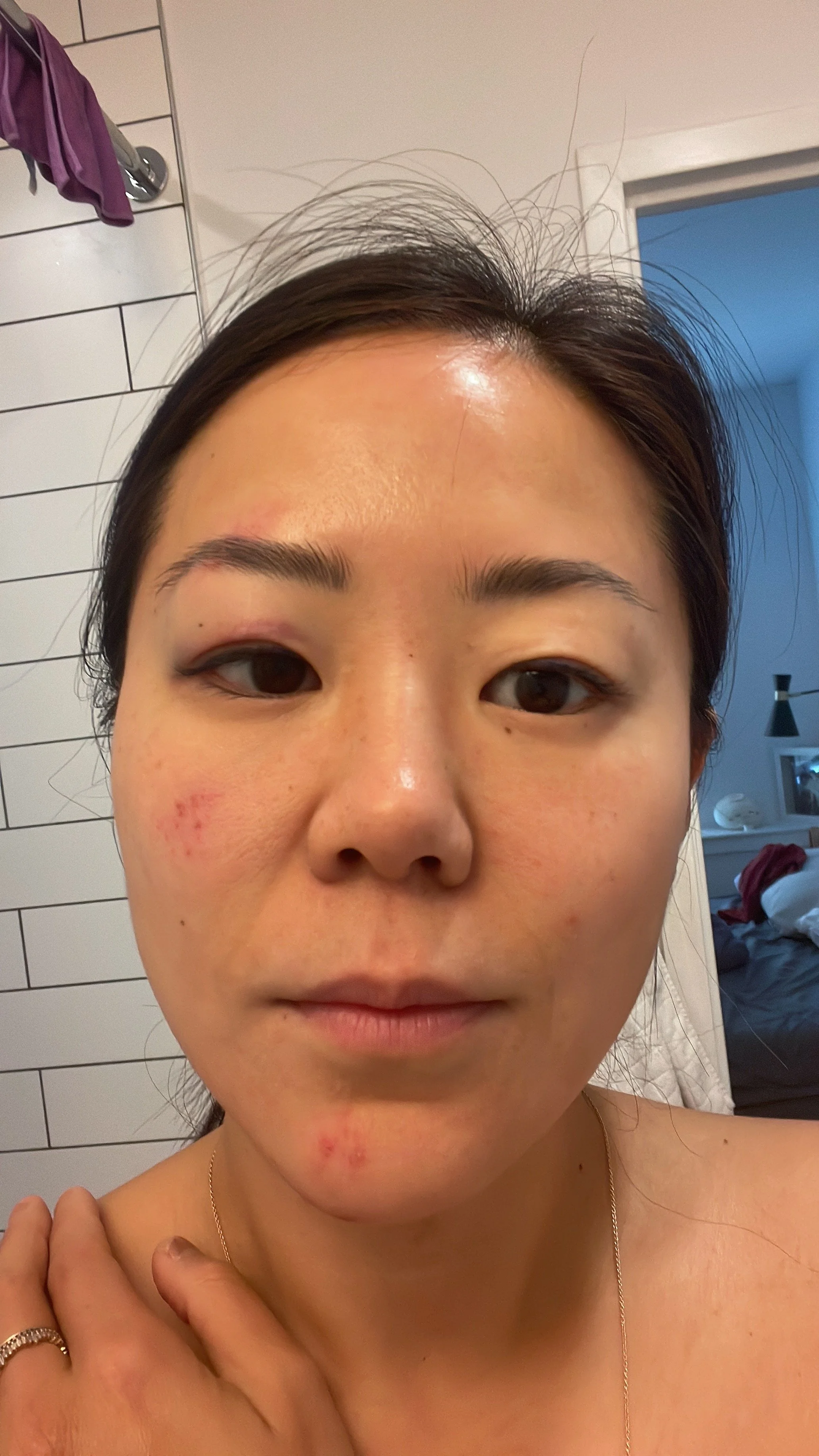 I was in the ER. Warning: Graphic photos inside. 