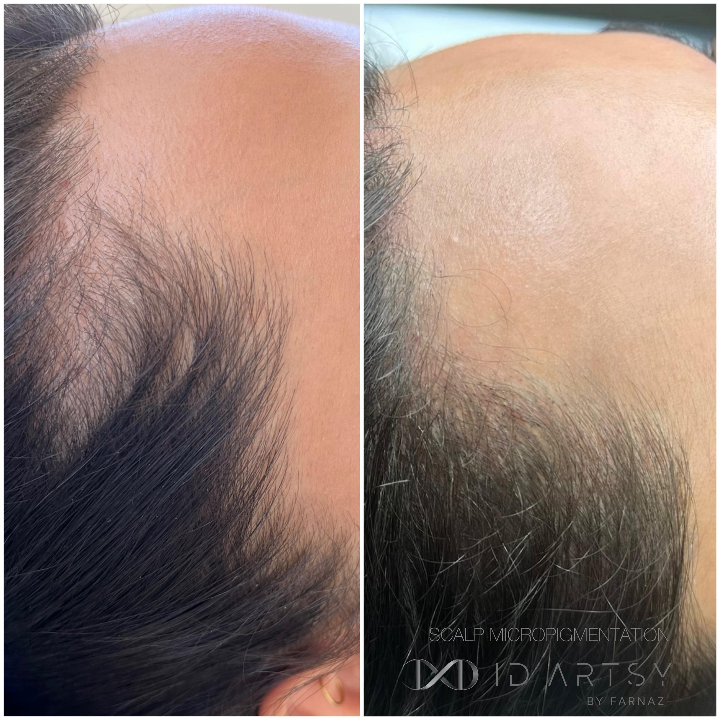 Scalp Micropigmentation.jpg