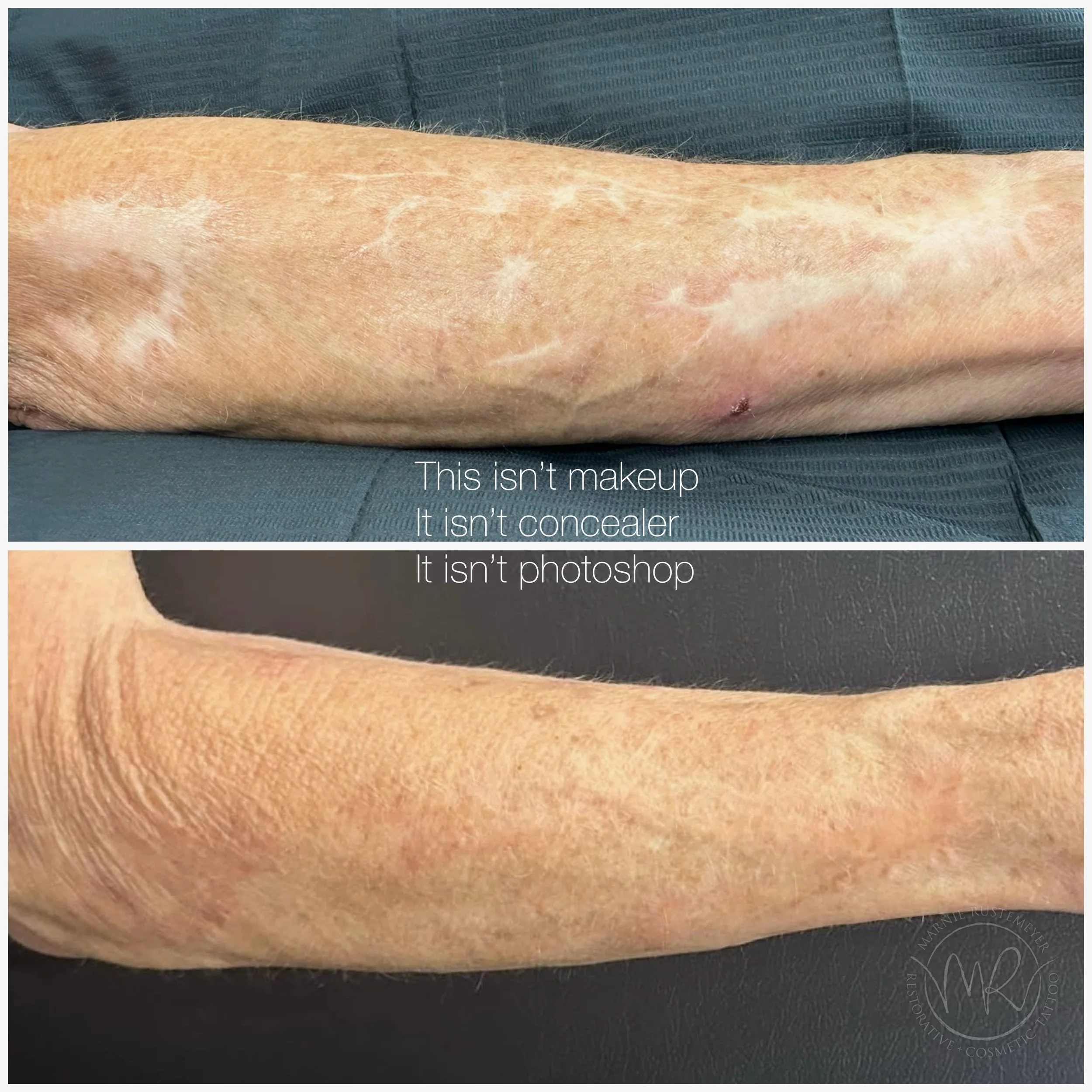 This is scar camouflage ✨ by @marnie.rustemeyer.tattoos 

A restorative tattoo procedure that uses carefully customized pigment to help certain scars blend more naturally with the surrounding skin.

Results aren&rsquo;t instant. Most clients require 