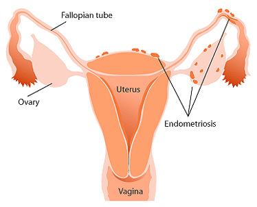 endometriosis_diag.gif