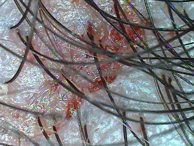 psoriasis 2.jpg