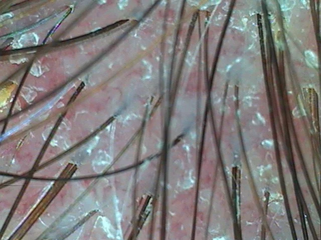 Example of a scalp condition with inflammation