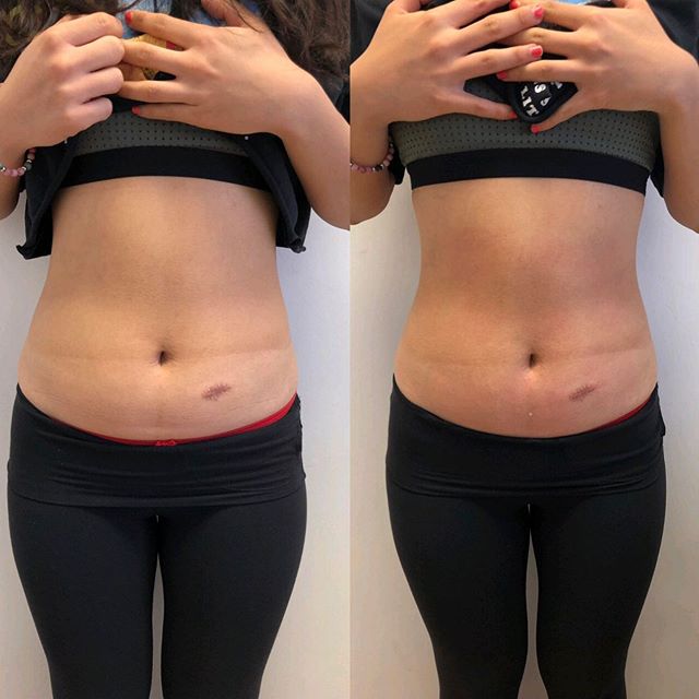 Ilipo! 1 session!! 2 inch loss. Gave her more of a waist. #ilipo #lipolaser
