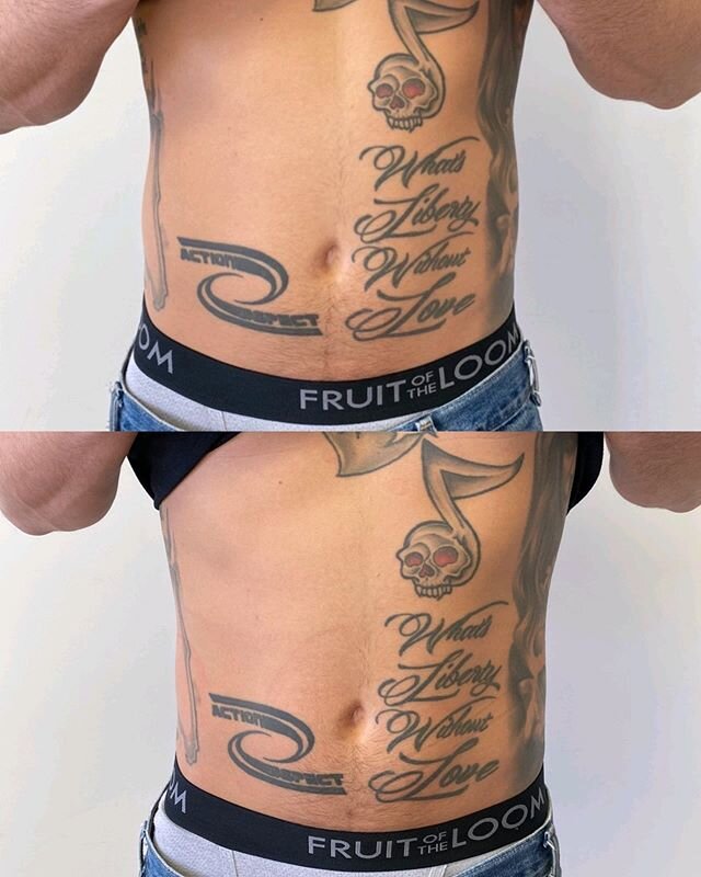1 session of Ilipo. #bodysculptbeverlyhills #ilipola #iliporesults #lipolaser #lipolaserla #ilipolosangeles #lipolaserlosangeles