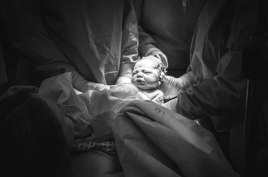 Photo of baby being born via cesarean birth