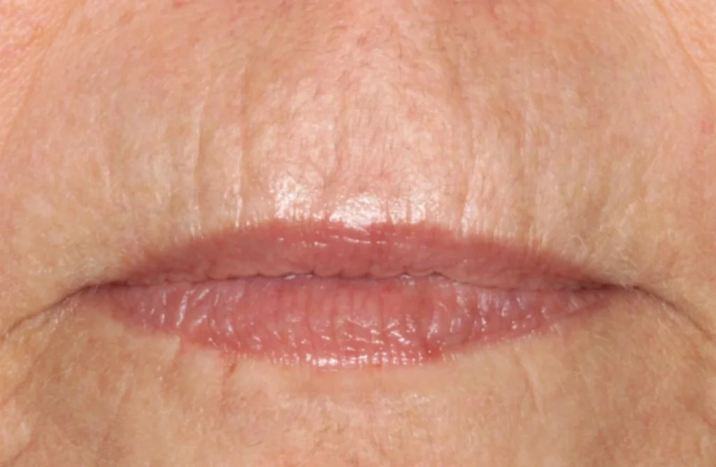 rynkebehandling_0002-1024x668.jpg