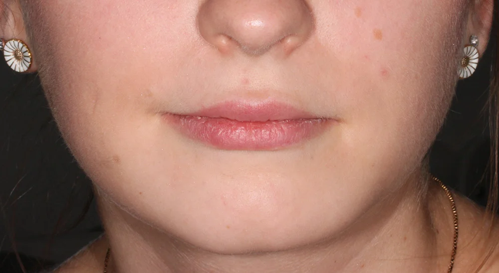 filler_laeber_restylane_foer.jpg