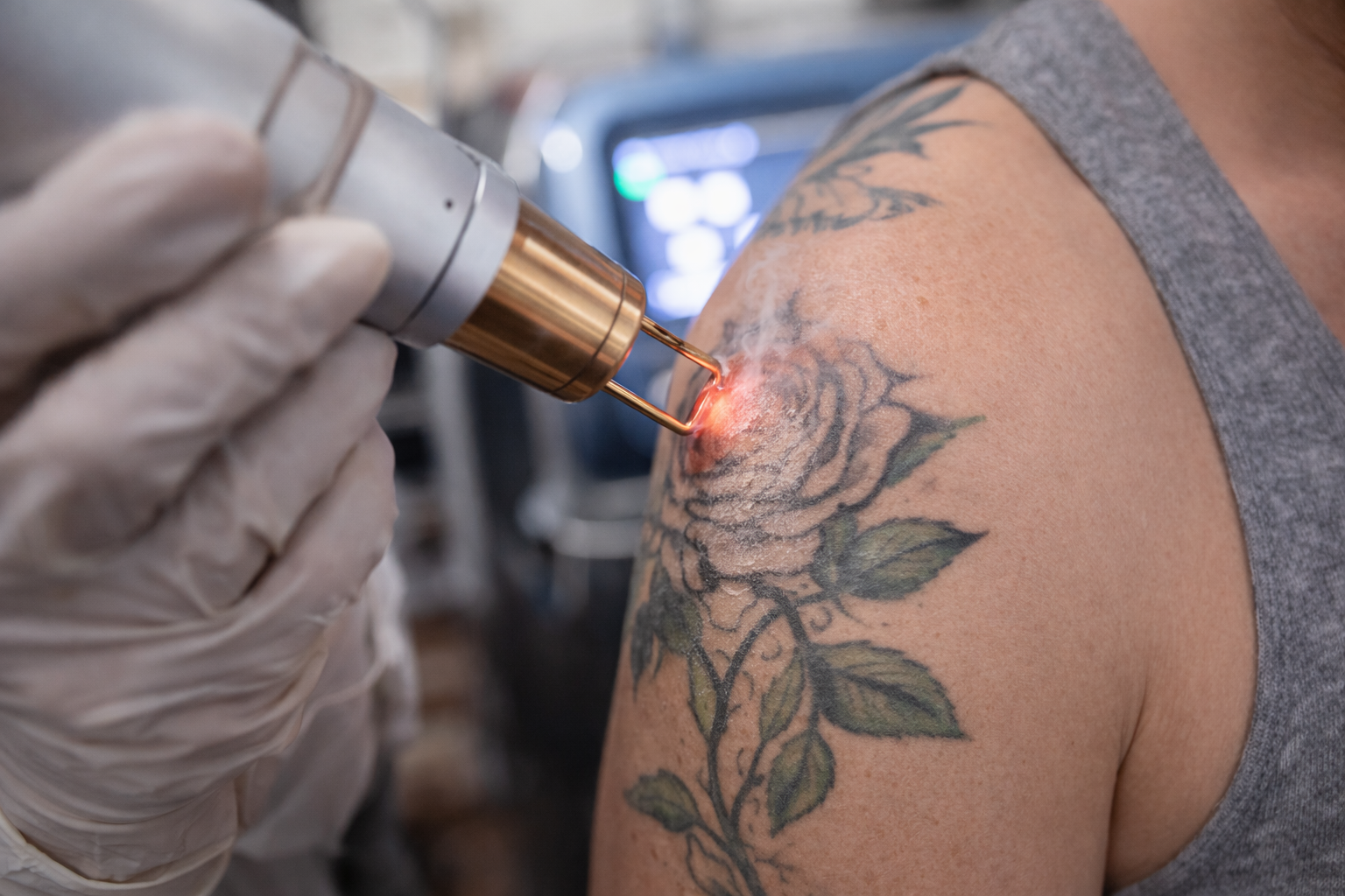 Tattoo fjernelse: Hvad er dine bedste muligheder?