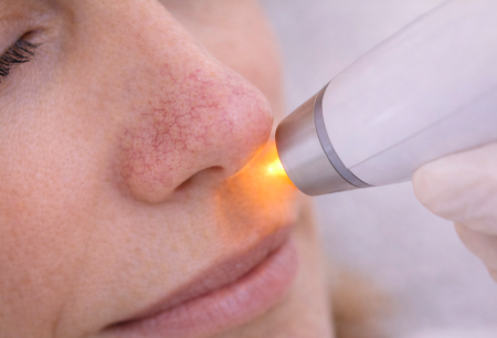 Karsprængninger på næsen: Sådan kan laserbehandling hjælpe