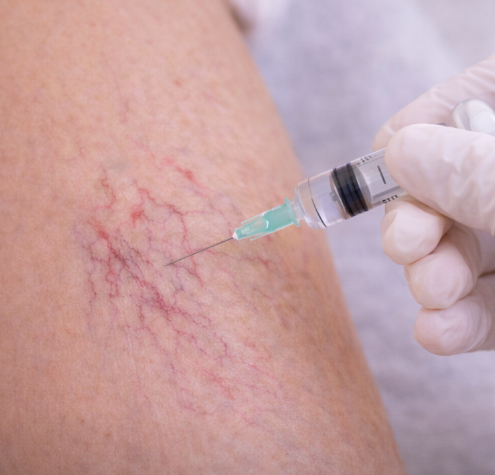 Behandling af karsprængninger: Hvilke metoder er mest effektive?