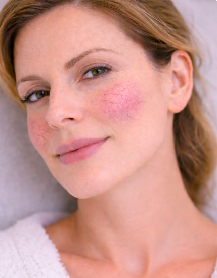 Karsprængninger i ansigtet: Årsager og behandlingsmuligheder