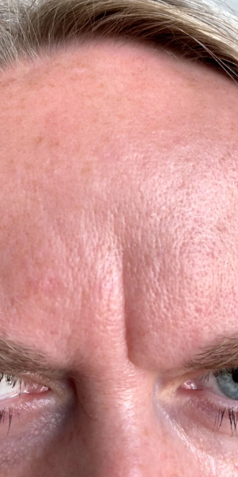 Botox behandling før billede