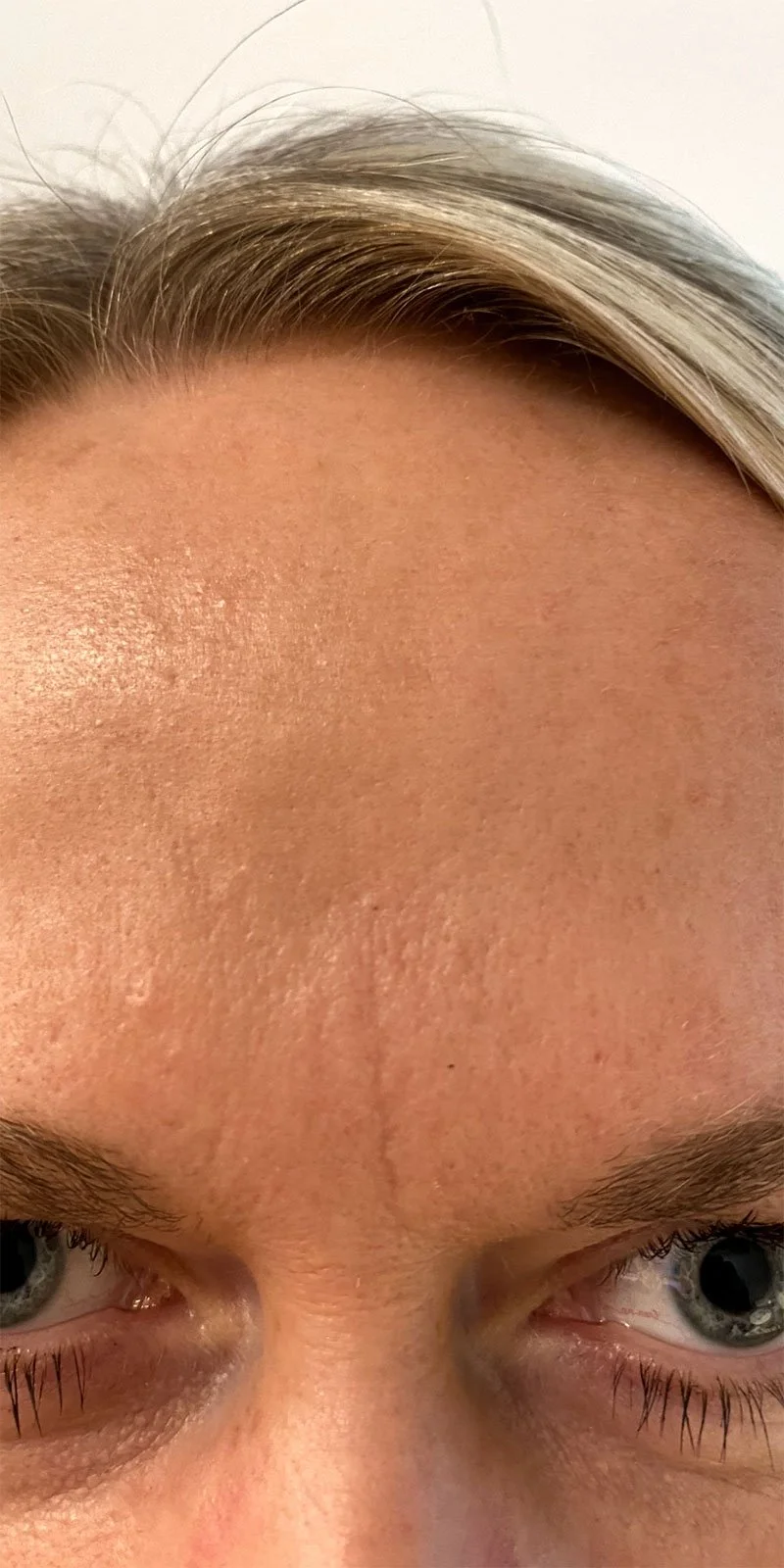 Botox behandling efter billede