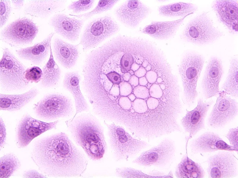 Elimination of Cervical Cancer as a Global Public Health Problem