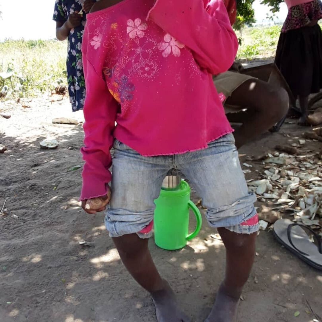 Tanzanian girl in need of correctional surgery identified by  our Outreach Team