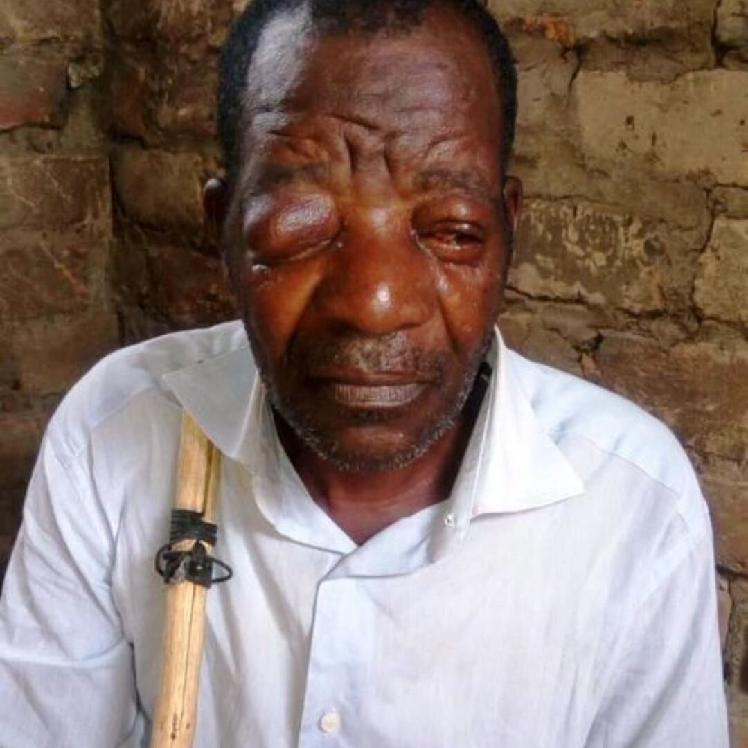 Man experienced blindness with untreated infection in his eyelid