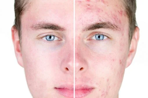 Acne – more than a skin disorder