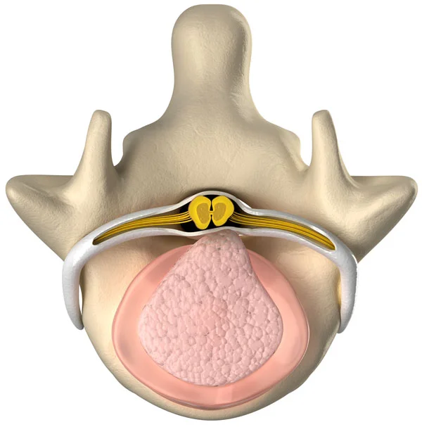 bulging_disc.jpg