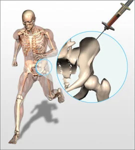 bone_marrow_draw-271x300.jpg