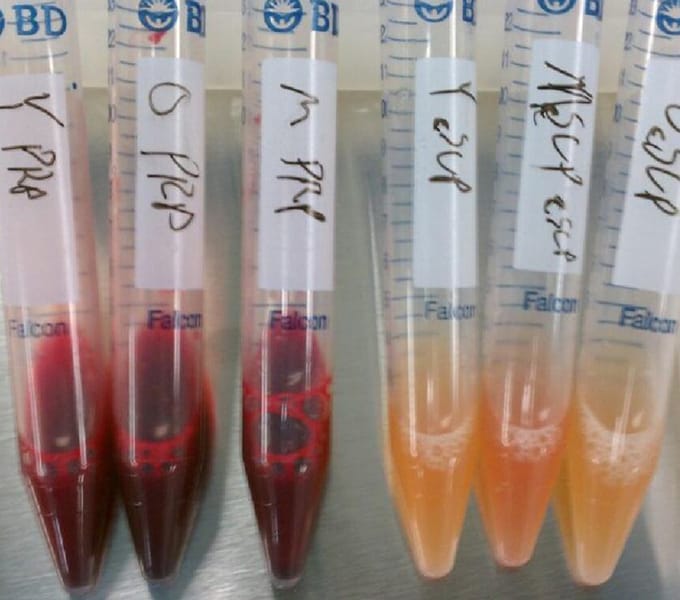 regenexx-experience-thrid-day-stem-cell-procedure.jpg