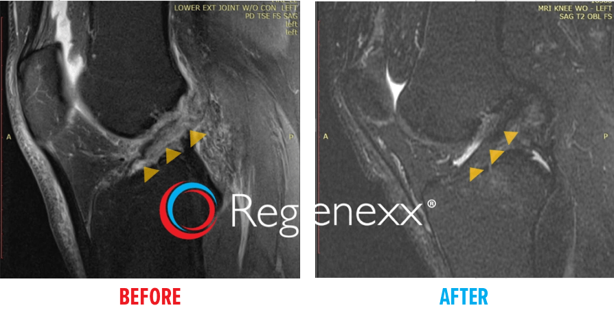 knee-mri-acl-tear-before-after1.png