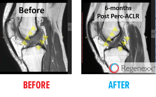 knee-mri-acl-tear-before-after5.png