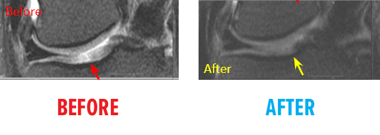 knee-osteochondral-defect-mri-before-after4.png