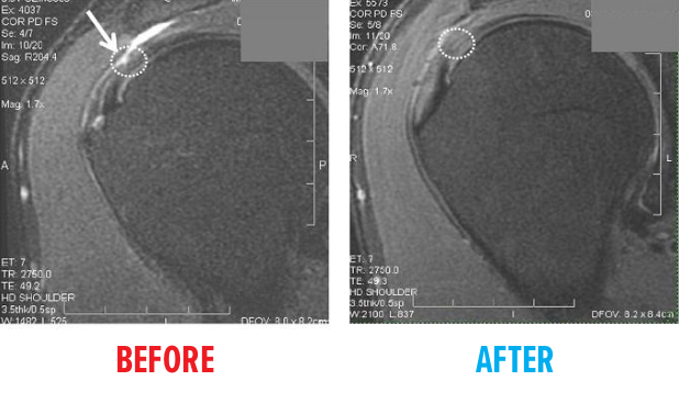 partial-tear-of-distal-supraspinatus-mri.png