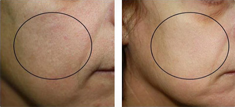Screenshot_2020-08-31 Skin Texture - OxyGeneo 3-in-1 Super Facial.png