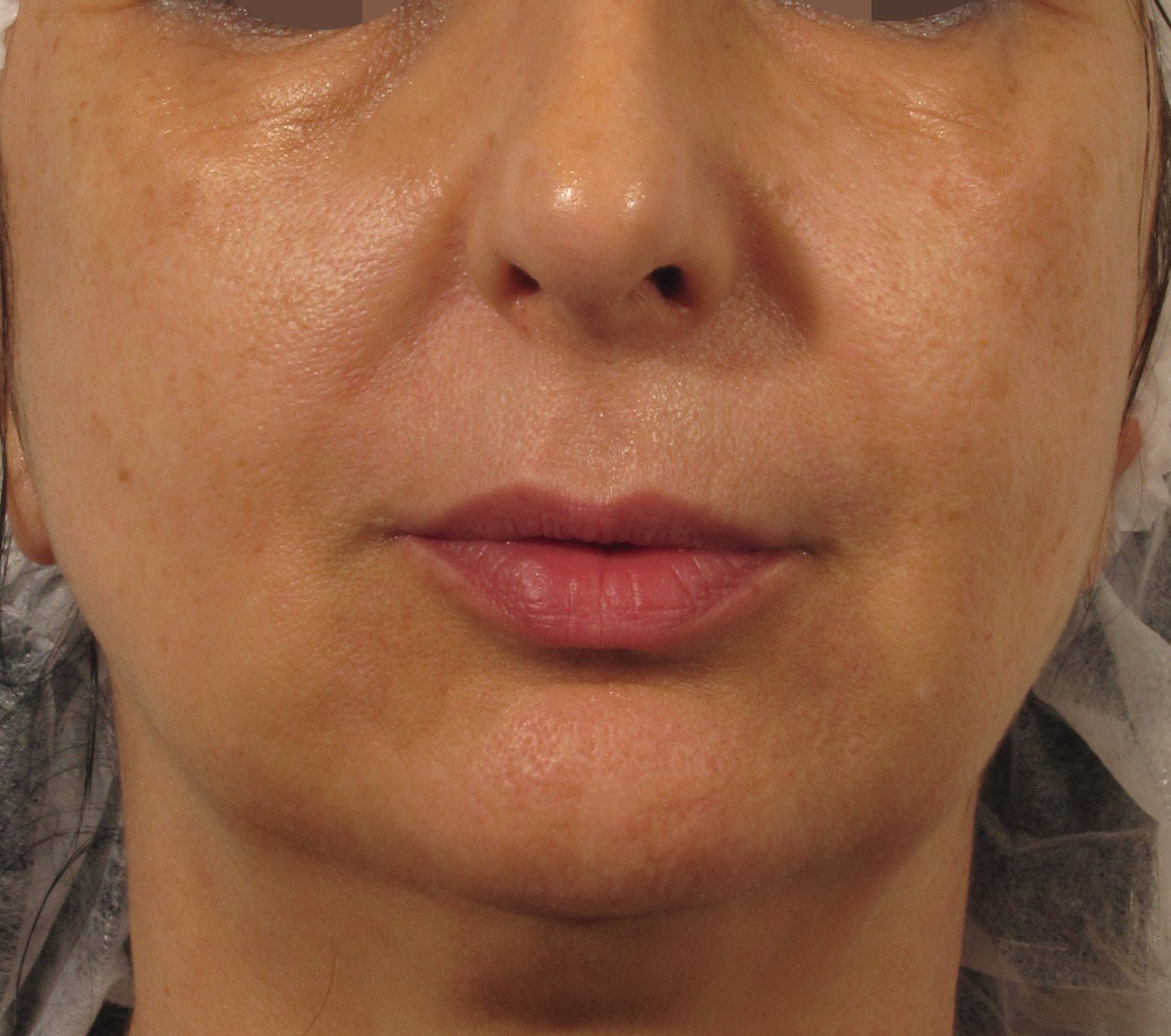 Oxygento After-Mouth-5-Treatments.jpg
