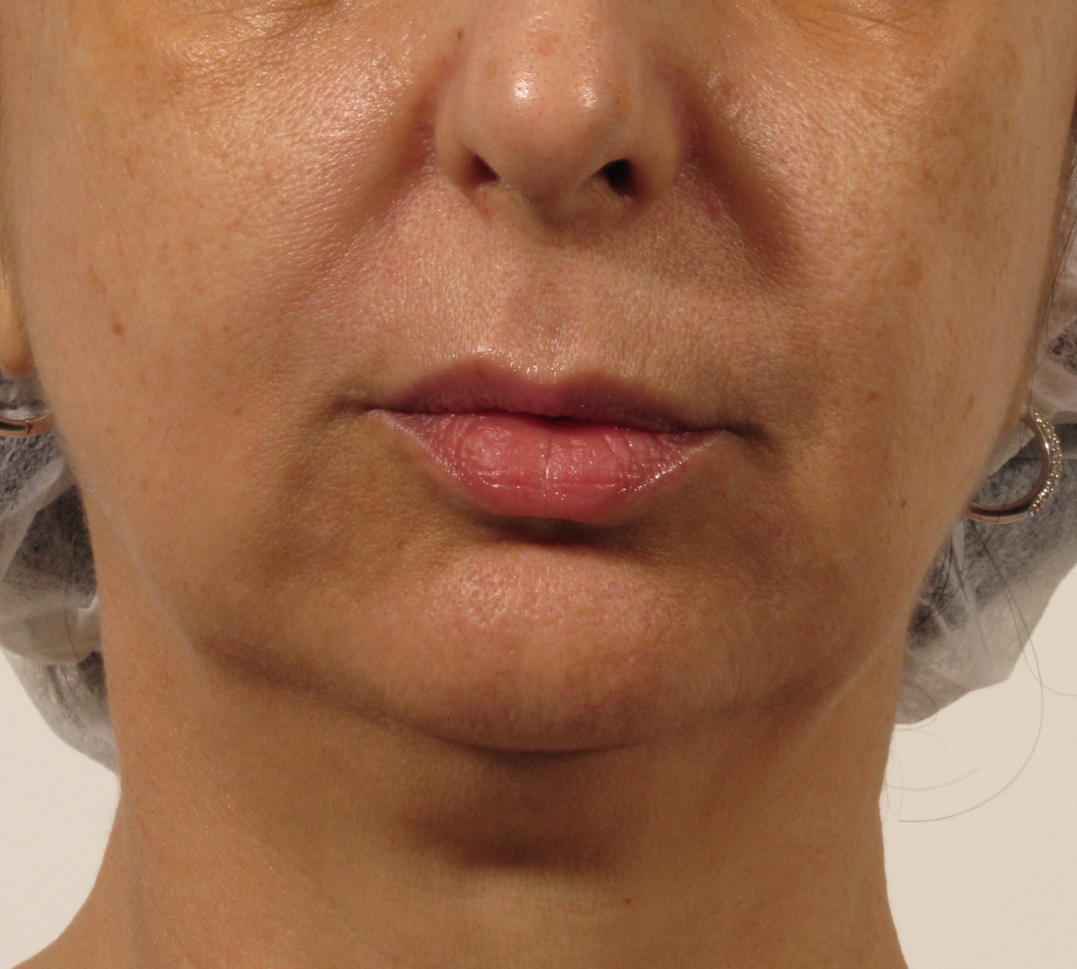 Oxygeneo4-Before-Mouth-Area.jpg