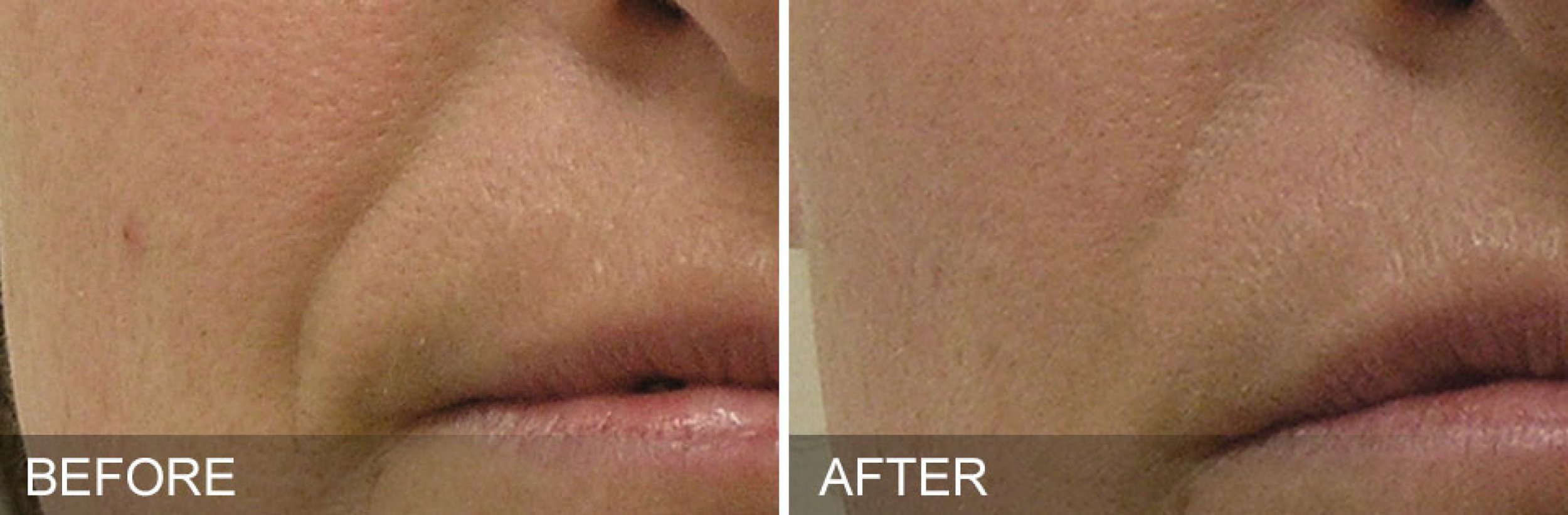 before and after hydrafacial.jpg
