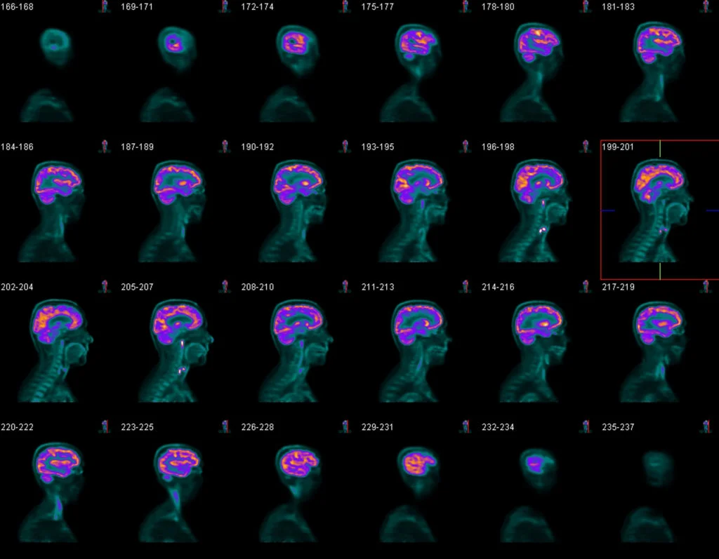 PET/CT Scans | Radiology Associates of Ocala — Radiology Associates of ...
