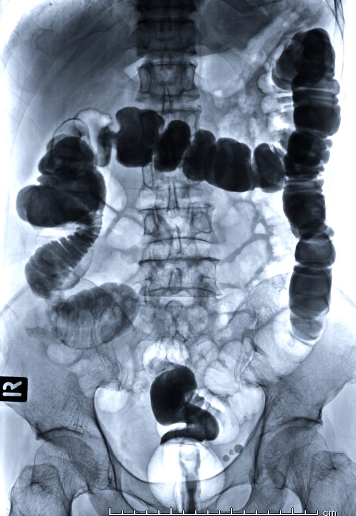 Computed Tomography Of The Abdomenpelvis Radiology Associates Of