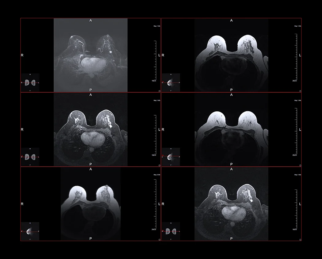 Breast MRI Article.jpg