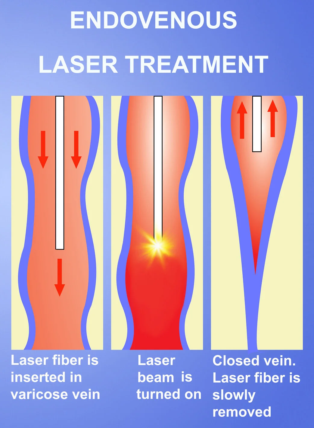 Get Rid of Varicose Veins Without Surgery! Radiology