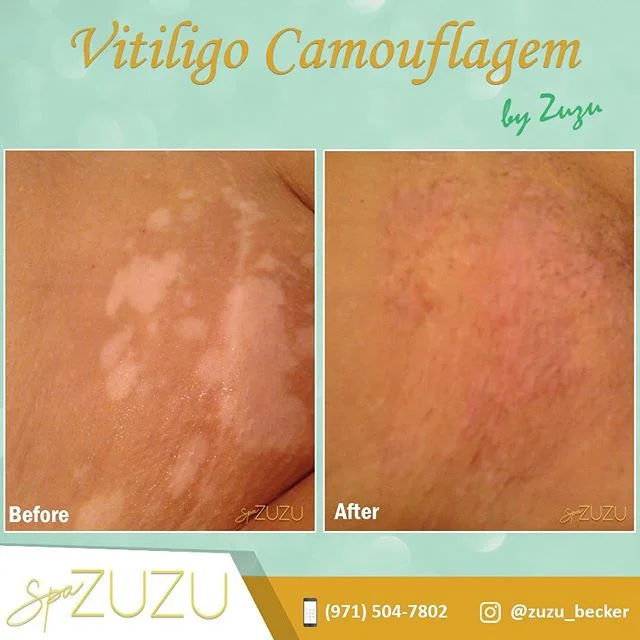 Vitiligo is a skin condition in which the skin loses pigment cells, resulting in discolored patches on your entire body, including the skin, hair, retina, and mucous membranes. Skin camouflaging evens out this pigmentation to improve your appearance.